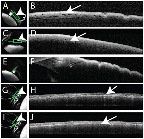 Aqueous Angiography And Optical Coherence Tomography Oct Aqueous Download Scientific Diagram