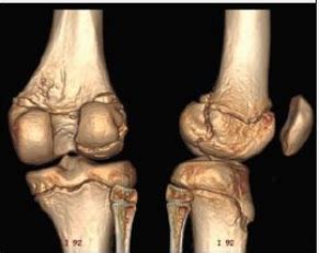 Coccyx X Ray Positioning IrvinnCesey