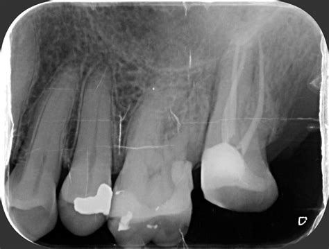 Radiograf A Periapical Radiograf