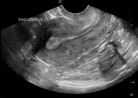 Early Pregnancy Sonoguide