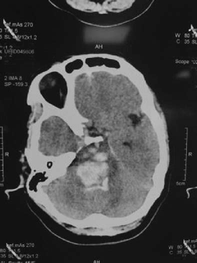 Plain Computed Tomography Scan Of The Head Showing Large Brain Stem