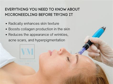 Everything You Need To Know About Microneedling Before Trying It