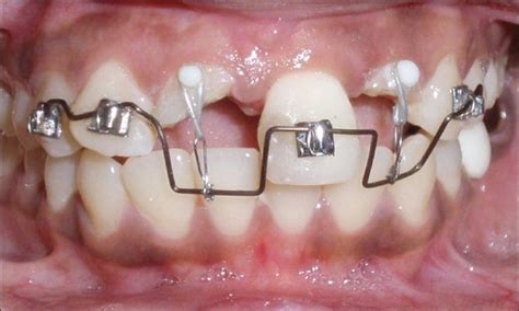 Customized Appliance In Place For Orthodontic Extrusion Download Scientific Diagram