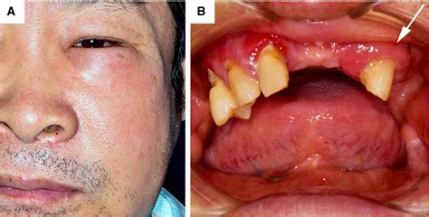 Odontogenic Facial Cellulitis Bmj Case Reports