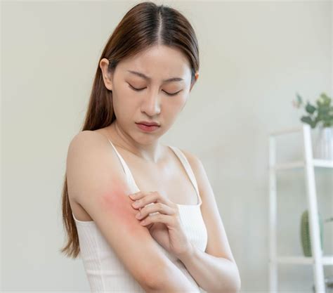 Eczema Treatment Plan Dr Reddys Venusia