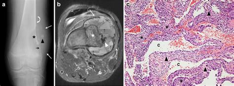 Telangiectatic osteosarcoma in a 17-year-old boy. a An initial... | Download Scientific Diagram