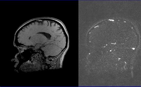 Phase Contrast Mri Phase Contrast Angiography Pca Venc Mri Physics