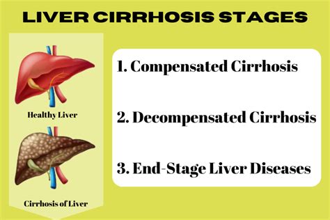 Liver Cirrhosis How To Cure Everything You Need To Know Qpior