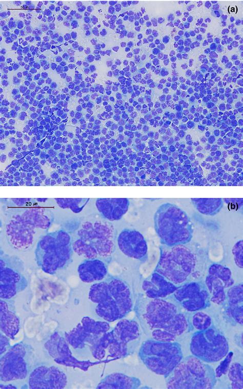 Multiple Cutaneous Plasmacytosis With Multilobated Clover‐leaf Shaped