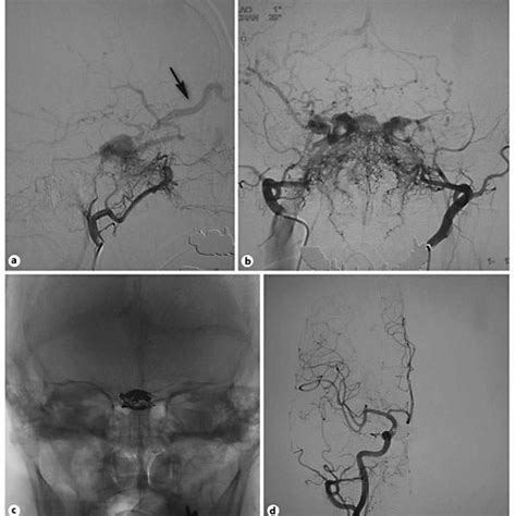 Right Internal Maxillary Selective Angiography With Dilated Superior Download Scientific