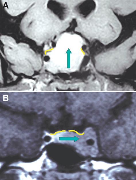 Diaphragma Sellae | The Neurosurgical Atlas