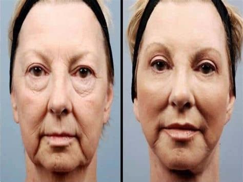 Fat Grafting To Face
