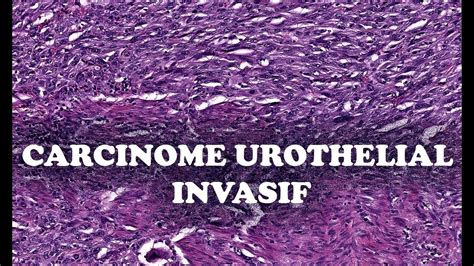 LE CARCINOME UROTHELIAL INVASIF Sous Types PATHOLOGIE YouTube