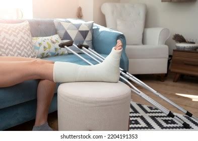 Broken Ankle Leg Cast Leg Splint Stock Photo Shutterstock