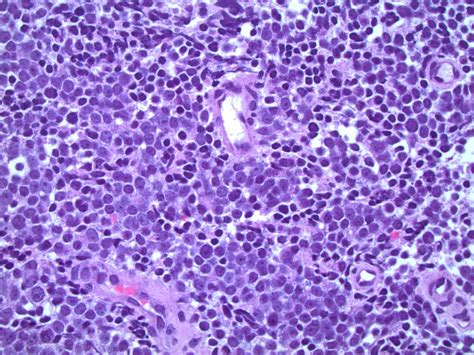 Pathology Outlines Small Cell Neuroendocrine Carcinoma