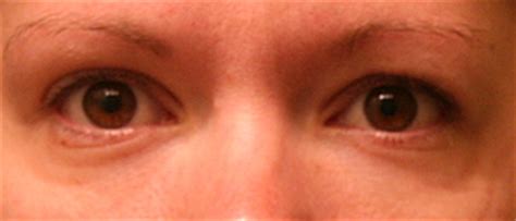 Does Preparation H Reduce Puffiness Around the Eyes? | Alpha Mom