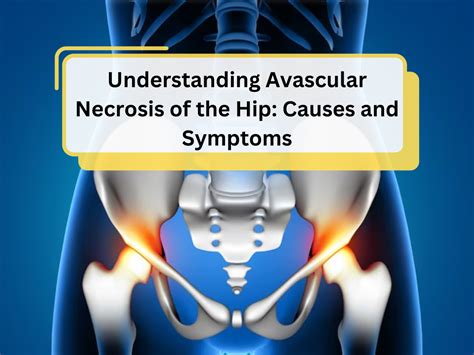 Understanding Avascular Necrosis Of The Hip Causes And Symptoms By