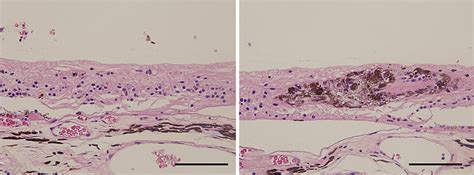 Histopathology Of The Retina And Choroid Retinal Architecture Is