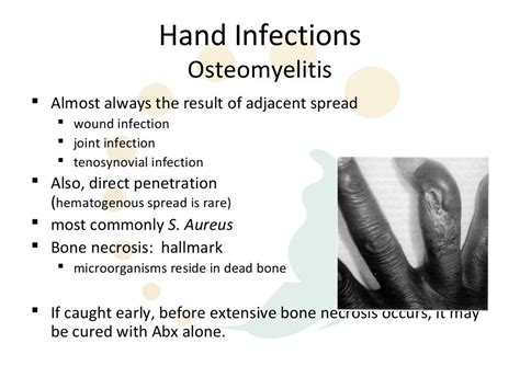 Hand infections