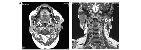 Synchronous Unilateral Basal Cell Adenoma Of The Parotid Gland A Case