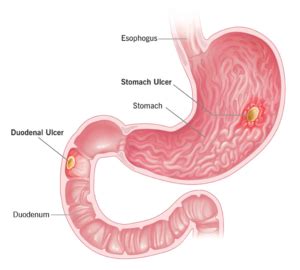 Ulcers After Gastric Bypass Surgery Bariatric Centers Of America