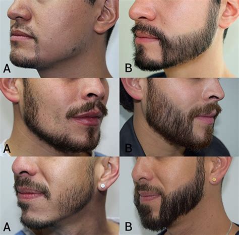 Beard And Mustache Transplant Ishrs