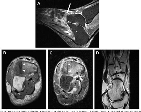 Figure From Mr Imaging Of Midfoot Injury Semantic Scholar