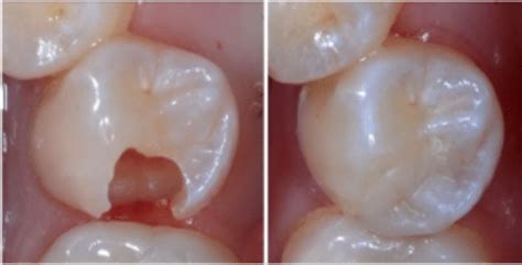 İnley ve Onley Seramik Dolgular Dentaluna Group Ağız ve Diş Sağlığı