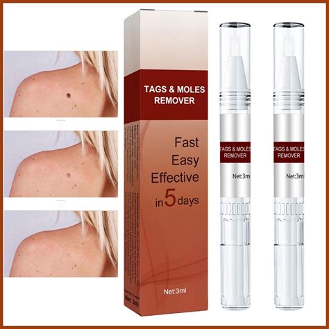 Mole Remover Mole Skin Tag Remover Mild Mole Removal Pen Easy To Wipe