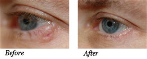 Eyelid Cancer Surgery St. Petersburg, FL