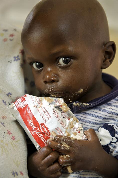 Gli Effetti Della Malnutrizione Sull Infanzia Unicef Italia