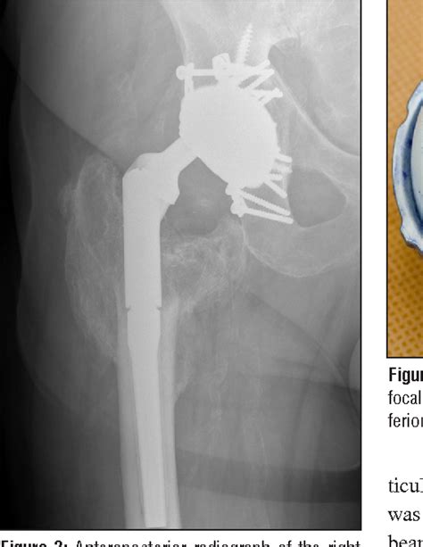 Figure 3 From Intraprosthetic Dislocation Of A Contemporary Dual Mobility Design Used During