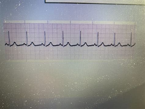 EXAM 1 EKGs Flashcards Quizlet