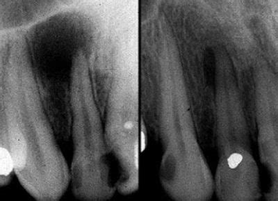 Granuloma Apical Dental - Endodoncia Avanzada