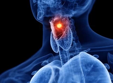 Vocal Cord Paralysis: Symptoms, Diagnosis, and Treatment