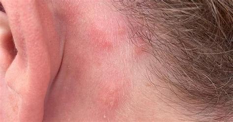 [19m] Weird Painful Red Lumps On The Left Side Of My Face Being My Left Ear And Neck Askdocs