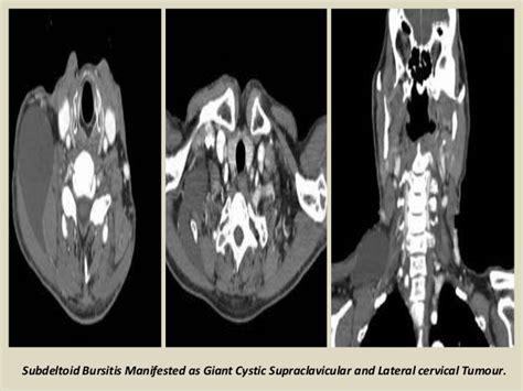 MRI Musculo-Skeletal Section: Bursa of shoulder.