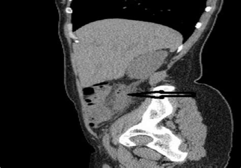 Tdm Abdomino Pelvienne En Coupe Sagittale Montrant Un Appendice Paissi