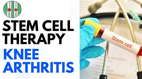 Stem Cell Therapy For Knee Arthritis Dr Randives Super Speciality