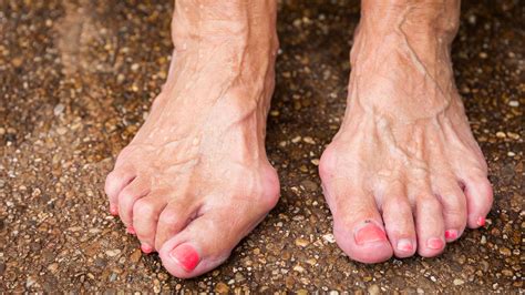 Hallux Valgus Causes Prevention Treatment Gesund Bund De