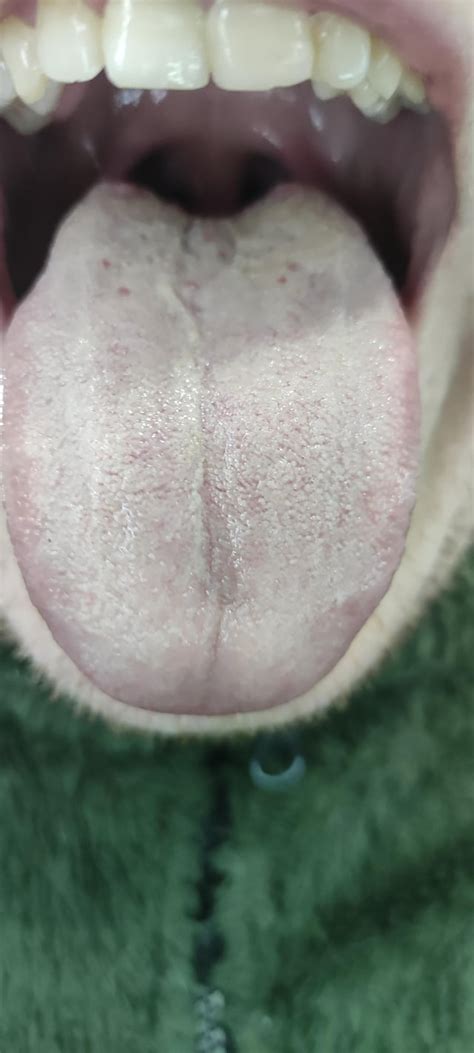 Fungal tongue? What can I do? : r/askdentists