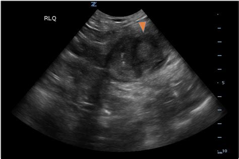 Imaging Findings Of Small Bowel Diverticulitis A Case Report Jetem