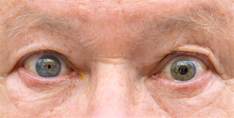 Anisocoria Unequal Pupil Size Symptoms And Causes