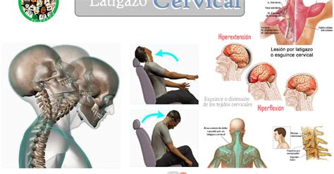 Agentes De Salud Latigazo Cervical