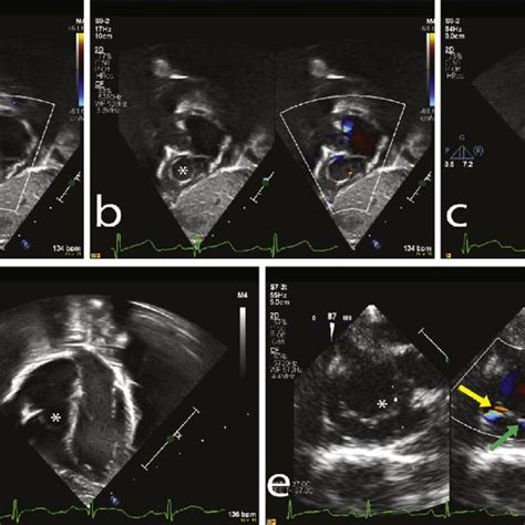 Subcostal Images Show The Membrane Above The Tricuspid Valve Download Scientific Diagram