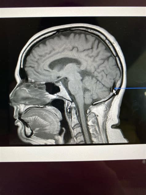 Is the confluence of Sinuses seen more on the right or left side? : r ...