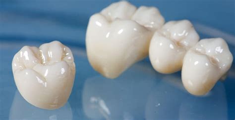 The Start-to-Finish Dental Crown Procedure Guide