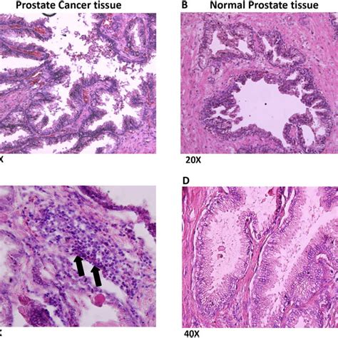 Prostate Cancer Cell Lines Display Increased Cell Surface Expression Of