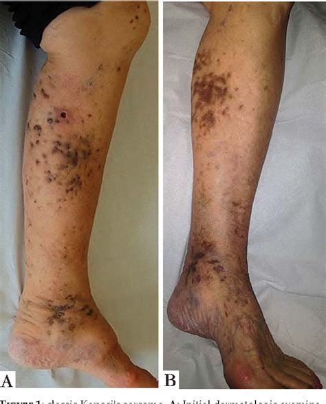 Figure 1 From Classic Kaposis Sarcoma Treated With Elastic Stockings