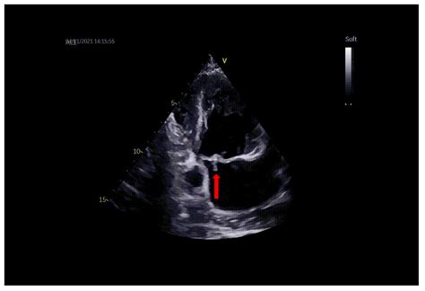 Diagnostics Free Full Text Surgical Atrial Septal Patch